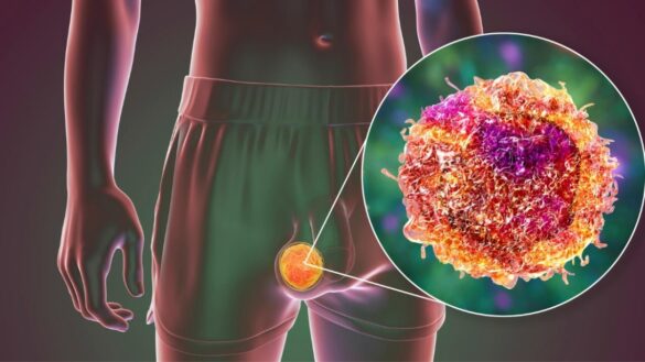 detectan-mayor-riesgo-de-cancer-testicular-en-personas-con-trastornos-del-neurodesarrollo