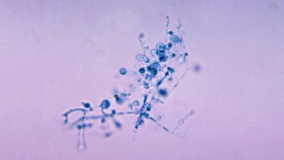 blastomicosis,-la-enfermedad-causada-por-un-hongo-que-se-ha-detectado-en-michigan