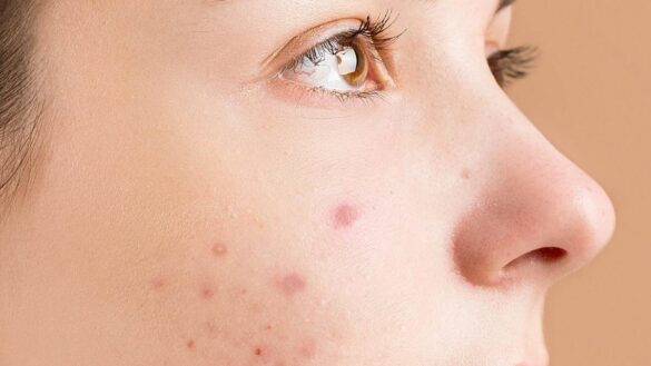 estos-son-los-efectos-secundarios-del-roacutan,-uno-de-los-medicamentos-mas-comunes-para-tratar-el-acne