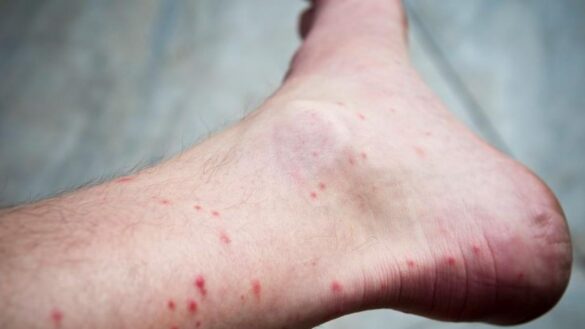 ¿que-son-las-picaduras-de-piojo-de-mar,-cuales-son-los-sintomas-y-como-se-curan?