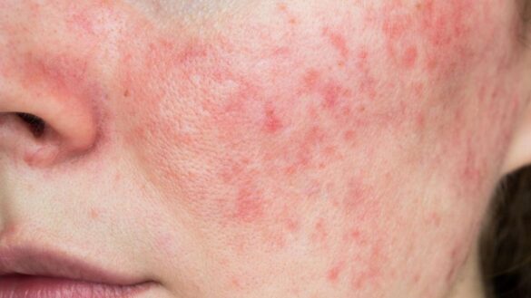 el-motivo-por-el-que-la-piel-se-inflama-y-se-irrita