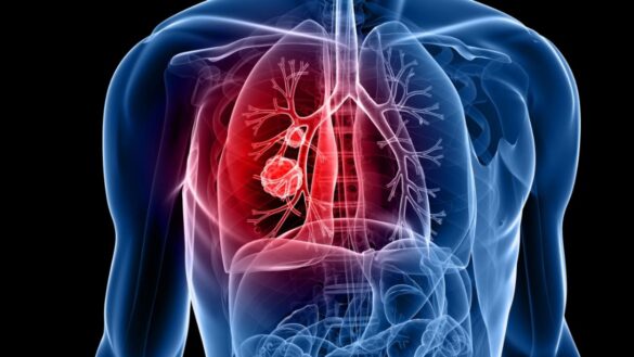 un-nuevo-farmaco-combinado-con-quimioterapia-duplica-la-supervivencia-en-cancer-de-pulmon