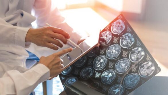 esclerosis-multiple:-estos-son-los-sintomas,-como-detectarlo-a-tiempo-y-la-posible-vacuna