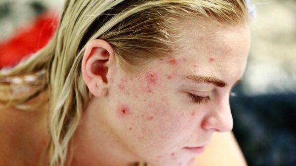 un-estudio-muestra-que-el-tratamiento-sin-antibioticos-para-mujeres-con-acne-persistente-es-eficaz