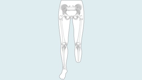 Amputacion transtibial