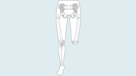 Desarticulacion de rodilla