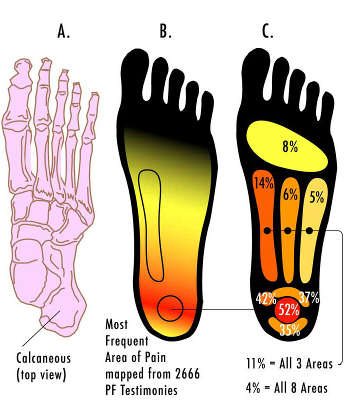 Fascitis Plantar